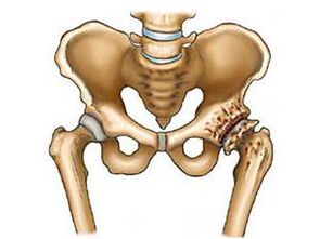 is arthrosis of the hip joint