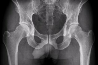 option for diagnosing hip joint arthrosis