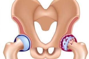 stage of development of hip joint arthrosis