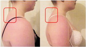 Muscle cushion formation in cervical osteochondrosis