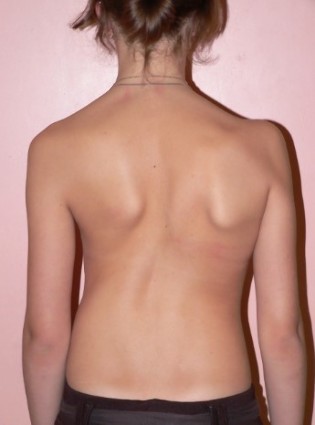 A scoliosis of 2 degree