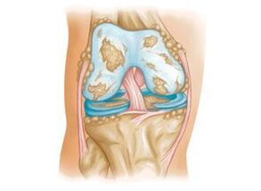 damage to the knee joint with arthrosis