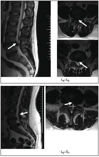 MRI scan of a herniated disc of the spine