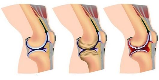 healthy and sore joints in the destruction of the knee joint