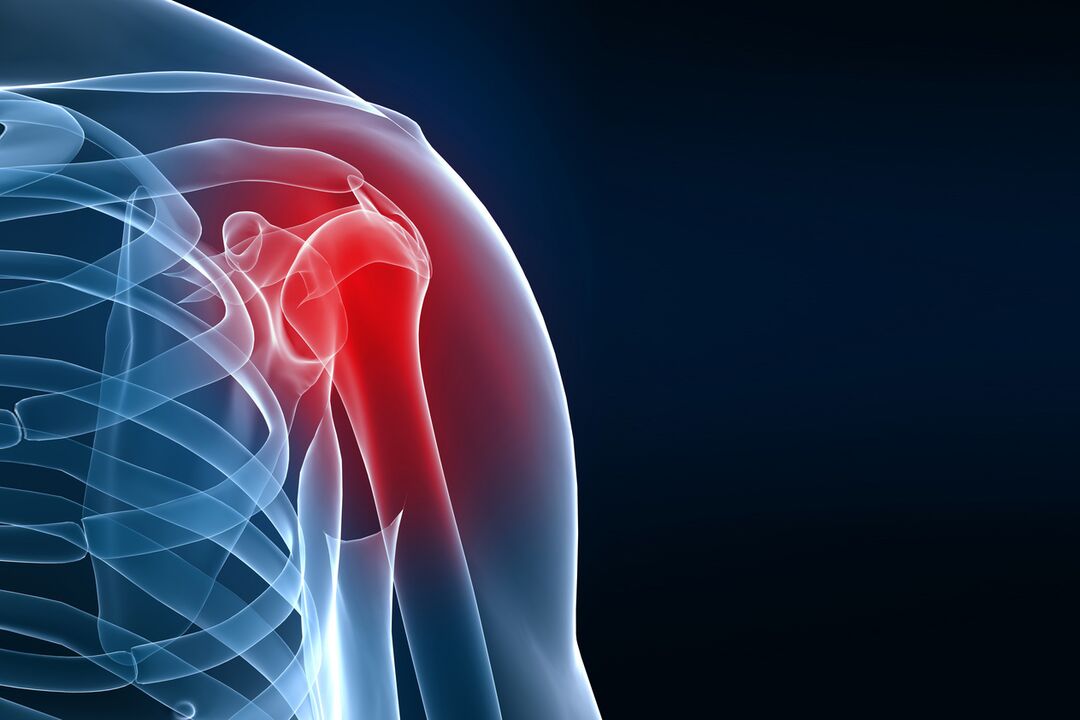 shoulder arthrosis