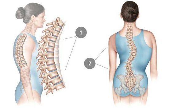 curvature of the spine as a cause of thoracic osteochondrosis