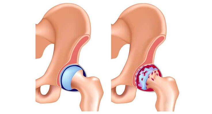 healthy and arthritic hip joints