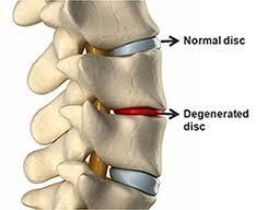 a normal disk in the spine with a damaged disc